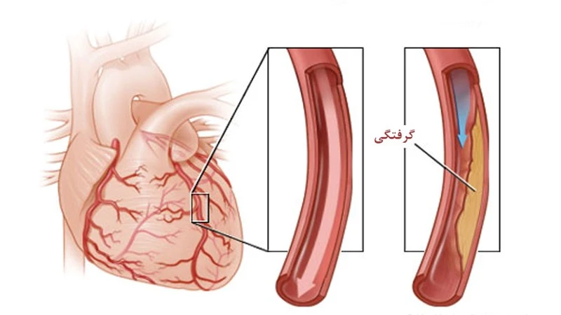 تنگی رگ های عروق قلبی 1